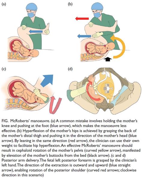 alarm shoulder dystocia|mcroberts position.